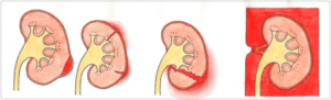 本並健治の腎臓破裂