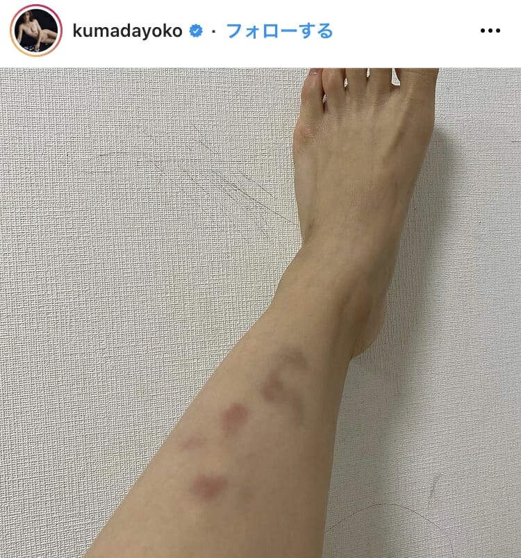 熊田曜子あざ腕の画像