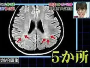 さとう珠緒の脳梗塞現在